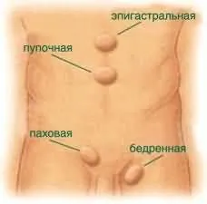 як вилікувати грижу на животі