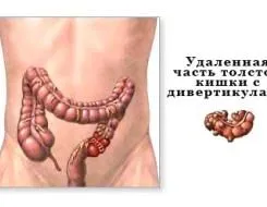 ерозивнийгастрит
