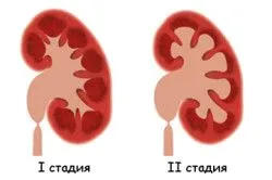 як лікувати гідронефроз нирки у дітей