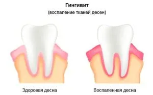 гінгівіт під час вагітності