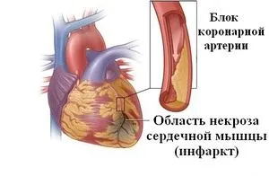 як лікувати тиск 140 на 90