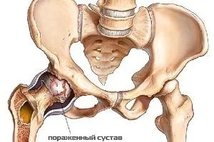 Яка дієта призначається при коксартрозе тазостегнового суглоба 1, 2 і 3 ступеня? як лікувати артроз 2 ступеня тазостегнового суглоба