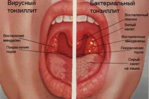 як лікувати гланди в горлі