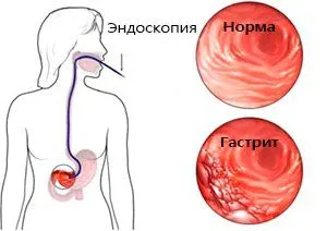 ерозивнийгастрит