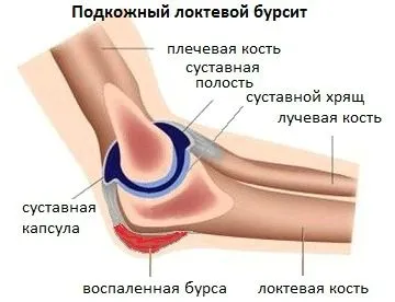 як лікувати хворобу бурсит