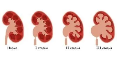 як лікувати хвороби нирки