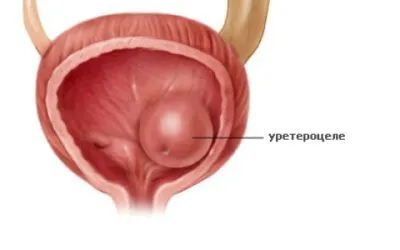 як лікувати хвороби нирки