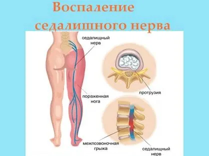 як лікувати радикуліт вправи