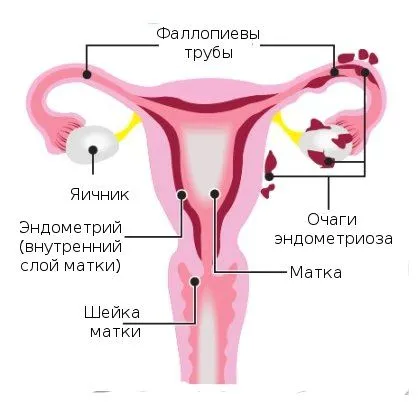 лікування ендометріозу