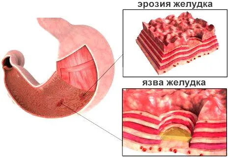 ерозивнийгастрит лікування