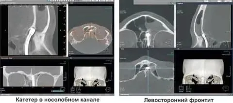 як лікують фронтит в лікарні