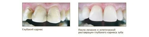 як лікувати гострий карієс