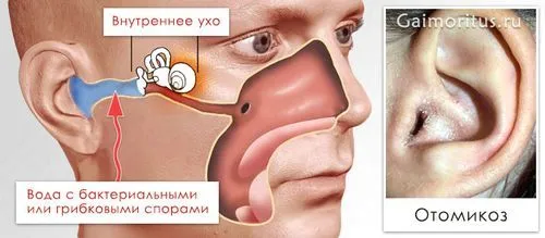 як лікувати вуха у людини