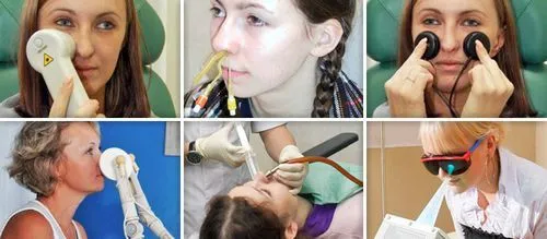 хронічний гайморит фізіотерапія