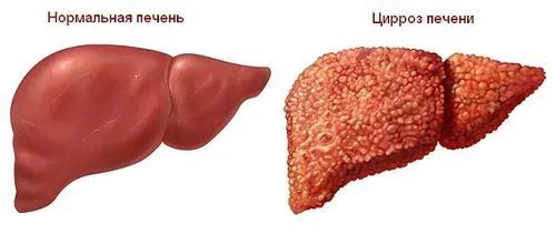 Цироз печінки: симптоми і форми патології як збити температуру при цирозі печінки