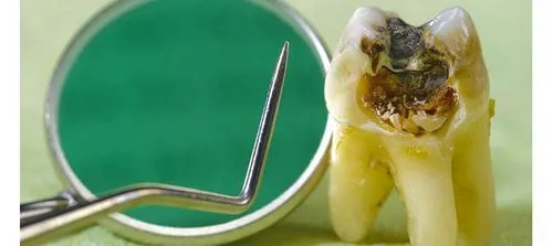 як лікувати гострий карієс