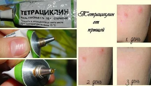 тетрациклін від прищів