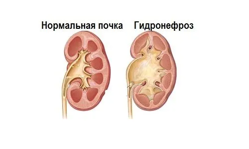 як лікувати гідронефроз нирки у дітей