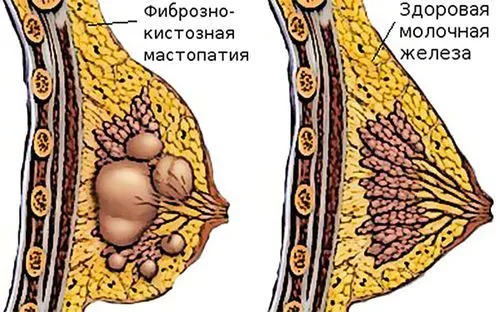 як лікувати мастопатію дифузну