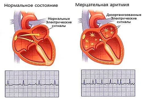 як лікувати нирки після фуросеміду