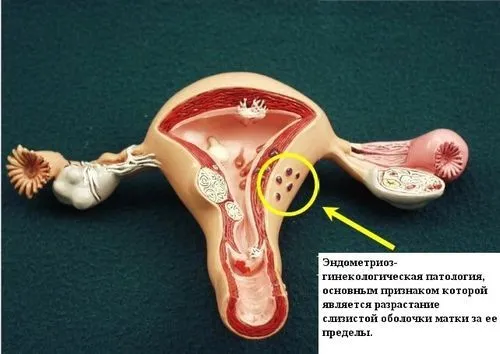 як лікувати ендометріоз і ендометрит