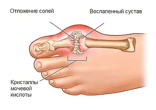 як лікувати нирки після фуросеміду