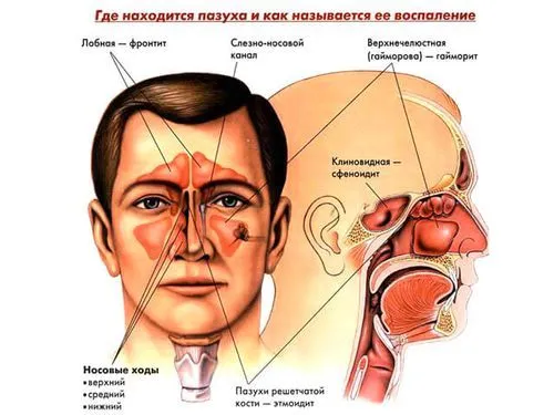 як лікувати грибковий синусит