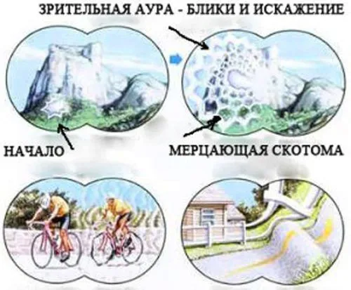 як лікувати очну мігрень