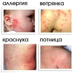 як виглядає вітрянка на ранній і пізній стадії