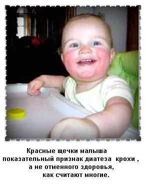 як лікувати діатез на щічках у грудничка