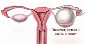 як лікувати кісту яєчника народними засобами