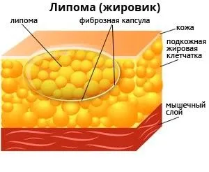 як позбутися від жировик під очима