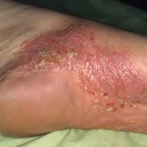 як лікувати ладонно підошовний псоріаз