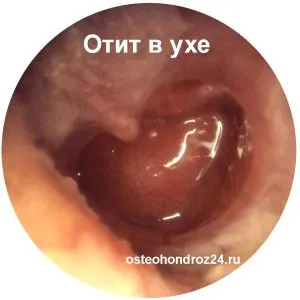 лікування отиту у дорослих симптоми ознаки види зовнішній гнійний гострий краплі антибіотики ускладнення