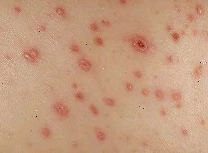 як лікувати вітрянку на ранній стадії