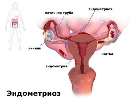 екстрагенітальний ендометріоз