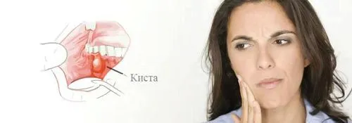 як лікувати кісту ясна