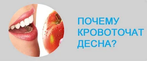 як лікувати ясна якщо вони кровоточать