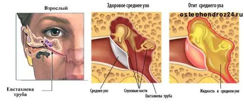 лікування отиту у дорослих симптоми ознаки види зовнішній гнійний гострий краплі антибіотики ускладнення