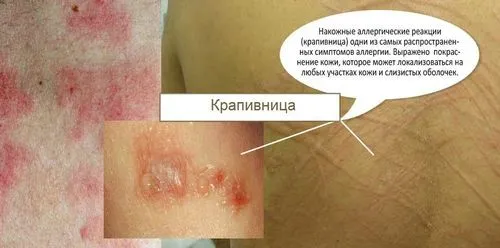 як лікувати медикаментозну кропивницю