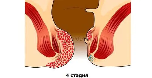як вилікувати геморой 4 ступеня