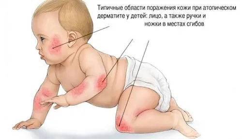як вилікувати атопічний дерматит у немовляти