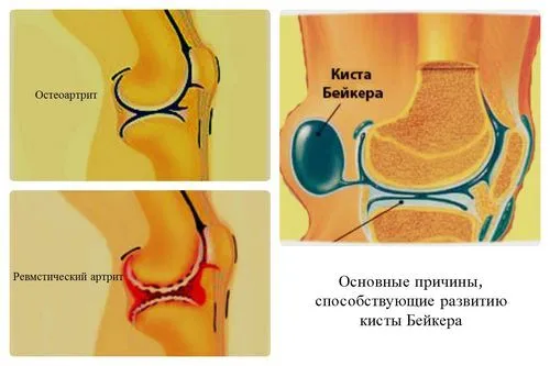 як вилікувати кісту кістки
