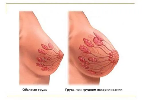 як лікувати мастит і лактостаз