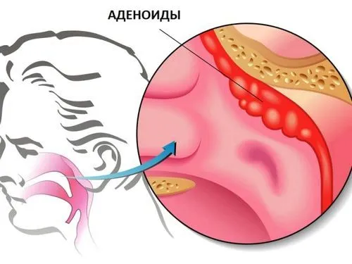 як ефективно лікувати аденоїди