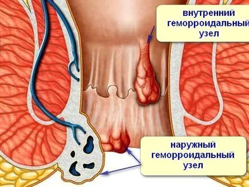 чи можна вилікувати геморой 2 ступеня