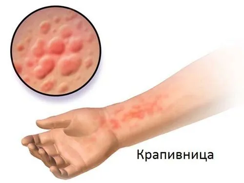 лікувати алергію активованим вугіллям