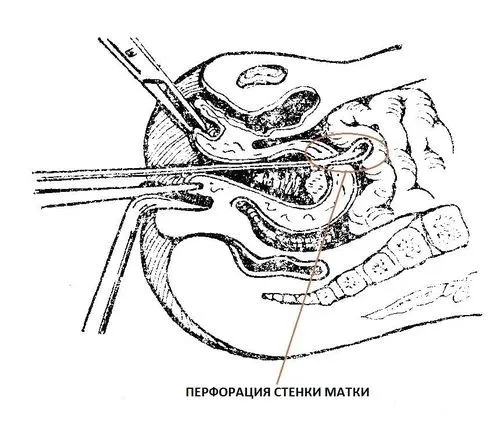 як лікувати гипопластический ендометрій