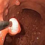 як лікувати рак шлунка содою