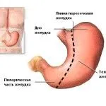 як лікувати рак шлунка содою
